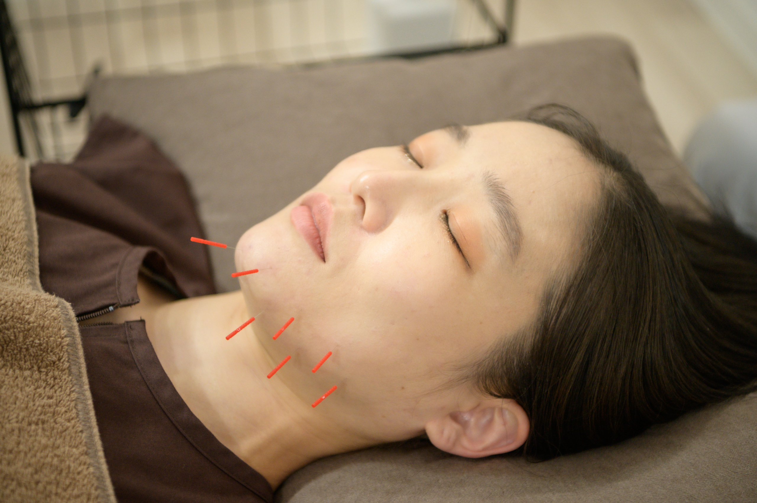 美容鍼灸の様子