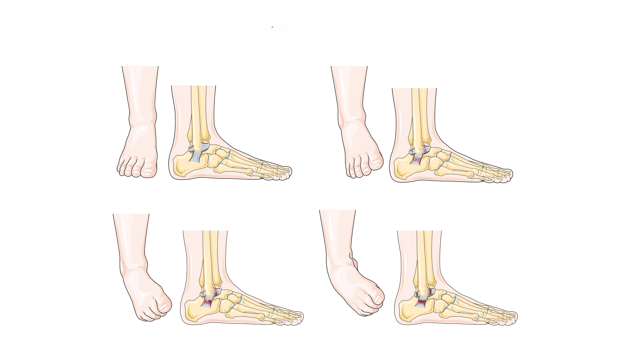 正常な足首と捻挫した足首の比較イラスト